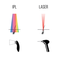 Why you might need it many women get fed up with having to shave, wax or pluck unwanted hairs on a regular basis. Cu FaÈ›a In Sus Rubin De FurtunÄƒ Ipl Vs Laser Hair Removal Lmvdesigns Com