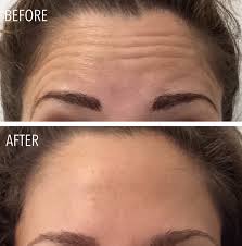 Botox injected into areas with larger muscles, such as the forehead tend to last shorter than areas such as crows feet. Botox Injections In Portland Maine Fantastic Results Competitive Pricing