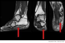 The muscles working on the foot can be distributed within the extrinsic and intrinsic muscles. Hindfoot Pain Baxter Neuropathy Reumatologia Clinica