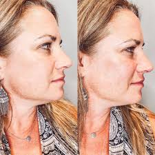 𝓟𝓻𝓸𝓯𝓲𝓵𝓮 𝓔𝓷𝓱𝓪𝓷𝓬𝓮𝓶𝓮𝓷𝓽 ✨ a little bit of filler can go a  long way- this patient was experiencing volume loss in her cheeks & needed  just a little refreshing! Subtle enhancements make the