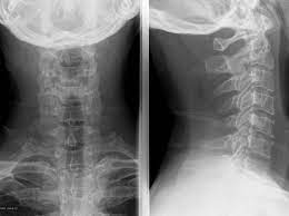 Qué es la artrosis cervical o cervicoartrosis se produce cuando se lesiona o degenera el cartílago de las articulaciones de la columna . Corregir La Rectificacion Cervical Es Posible Www Medspine Es