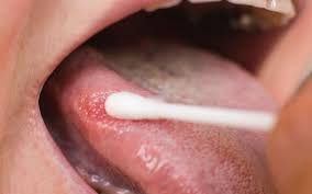 Image result for gum cancer symptoms