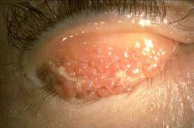 Image result for Vernal Conjunctivitis