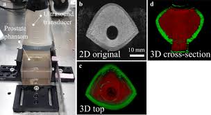 We did not find results for: A High Fidelity Phantom For The Simulation And Quantitative Evaluation Of Transurethral Resection Of The Prostate Springerlink