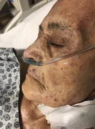 Image result for scabies norvegica