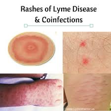 Rashes Of Lyme Disease Coinfections Lyme Warrior Lyme Disease Lyme Lyme Disease Awareness