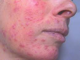 Il existe plusieurs formes de rosacée : Dermato Info La Couperose Et La Rosacee