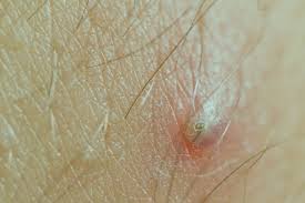 Also, gently exfoliate a day after the wax if the area isn't red, inflamed or irritated. How To Prevent Bumps And Acne After Waxing Thehealthmania