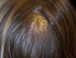 Hair loss is harder to treat when a person has already lost an extreme amount of hair. Hair Loss Dermnet Nz