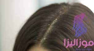 افضل علاج لقشرة الشعر المزمنة والتخلص منها Oils For Dandruff Dandruff Oils