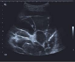 Light and rodriguez have proposed a classification and treatment scheme for pleural effusion based on the amount of fluid, gross and biochemical characteristics of fluid, and whether the fluid is loculated.18according to their classification, a transudate is considered as uncomplicated effusion, which can be managed by conservative treatment or antibiotics alone. Ultrasound Image Of Multiple Septations And Loculations In A Patient Download Scientific Diagram
