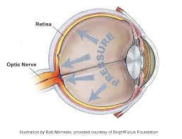 glaucoma and eye pressure how high is too high