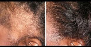 How To Grow Your Edges Back In 2 Weeks Youtube Black Hair Edges Grow Black Hair Edges Hair