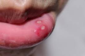 Image result for Lip Cancer