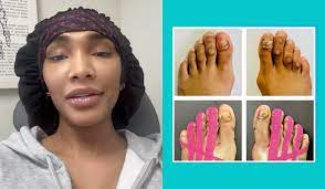 Tokyo Stylez Remains Transparent Ahead Of Foot Surgery To Remove Corns,  Bunions And More: 'I've Been Terrified To Show My Feet, But Enough Is  Enough'