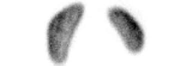 La scintigraphie thyroïdienne est une technique d'imagerie de médecine nucléaire qui consiste à injecter l'agent traceur radioactif iode 123 ou 131 qui se fixe sur la glande thyroïde, puis à le détecter. Scintigraphie Renale Dmsa Ou Dtpa Mag 3 En Bretagne