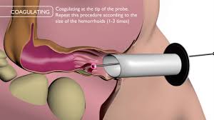 L'hémorroïdectomie « classique » qui retire les hémorroïdes (technique volontairement laissées ouvertes (figure 1), les hémorroïdes internes et externes sont enlevées. Hemorroides Docteur Desantis Chirurgie Viscerale Et Digestive