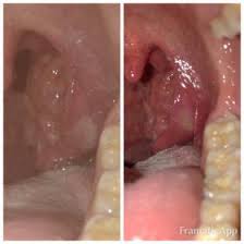 Weisser Fleck Wunde Im Mund Denta Beaute