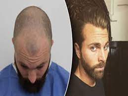 The majority of androgenetic alopecia (or male pattern baldness) sufferers start noticing their hair loss in their mid to late twenties. Is There A Way Out For Hair Loss At 20 Layla Hair Shine Your Beauty