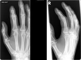 Image result for Hand Growth Plates