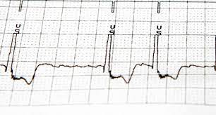 Vorhofflimmern Katheterablation Effektiver Aber Riskanter Als