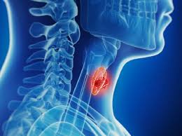 Ung thư tuyến giáp là một loại ung thư hiếm gặp và thường xuất hiện đầu tiên với một khối u cứng ở phía trước cổ nhưng ít người biết đến dấu hiệu này. Ung ThÆ° Tuyáº¿n Giap Thá»ƒ Nhu Sá»'ng Ä'Æ°á»£c Bao Lau