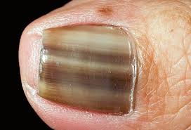 Pictures Of Toenail Colors And What They Mean The nail protects the nail bed, the skin at the upper tip of the finger or toe.