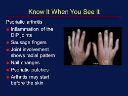 Psoriatic Arthritis Symptoms Diet Treatment How To Relief