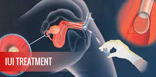 Intrauterine insemination or iui procedure can be considered the start of the fertility treatment process. Is Iui Right For You