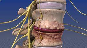 Thoracolumbar Spine Infections Usc Spine Center Los Angeles