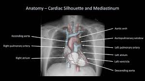 There are many approaches to cxr interpretation, each trying to ensure that key abnormalities are identified and no area is. Chest X Ray Interpretation Made Easy Faculty Of Medicine