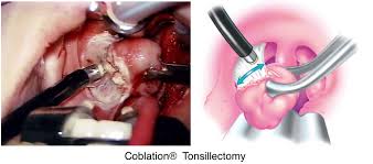 Image result for Tonsillectomy