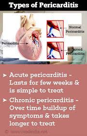 Diagnosis of constrictive pericarditis by tagged cine magnetic resonance. Pericarditis Causes Symptoms And Signs Diagnosis Treatment