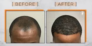 If you have genetic male or female pattern hair loss, these products may help. Black Men Hair Transplant Afro Textured Hair Loss Replacement