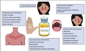 Image result for Hydroxychloroquine