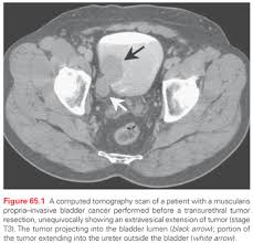 Can You See Bladder Cancer On Ct Scan Ct Scan Machine