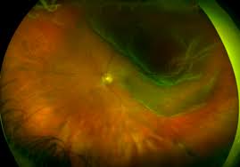 A scan to show a healthy eye or detect disease. Retinal Detachment Recognizing Pathology Optos