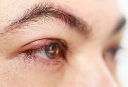 Comment Retirer Un Verre De Contact Brise Trucs Pratiques