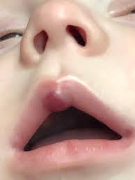 Cherry angioma is the most common type of angioma. Hemangioma On Lip August 2018 Babies Forums What To Expect