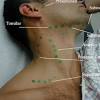 Back of neck anatomy lymph. 3
