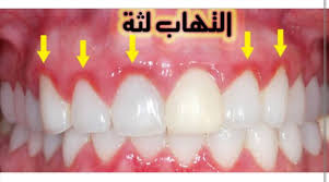 امراض اللثه صورة للثه الملتهبه واللثه عيادة الابتسامة الامثل لطب الاسنان Facebook