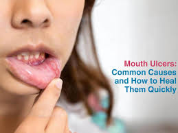 Image result for mouth ulcer on tongue)