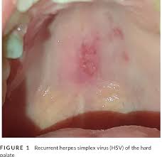 Image result for Oral herpes roof of mouth
