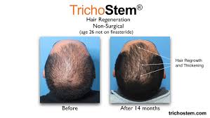 These hair loss causes can happen at any age, and will usually continue until the external factors have been addressed. Case Study Early Male Pattern Hair Loss Without Finasteride