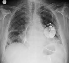 Pacemakers and implantable cardioverter defibrillators (icd) both use wires called leads to send electrical signals to the heart. Cardioverter Defibrillators Icd Or Aicd Brandenburg Heart Center
