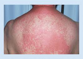 Some of the edible acids and oils also react to. Contemporary Infectious Exanthems An Update Future Microbiology