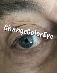 Eye Color In 2020 Eye Color Change Eye Color Change Surgery Eye Color
