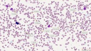 Medical definition of target cell: Haemoglobin Sc Disease Learnhaem Haematology Made Simple