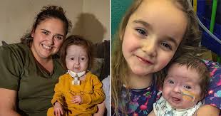 The condition is sometimes called 'benjamin button disease' for this reason, a reference to the f.scott fitzgerald story 'the curious case of benjamin button' in which mr button is born elderly and. Two Year Old Isla Is The Only Child In The World With This Benjamin Button Condition Metro News