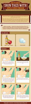How To Remove Skin Tags At Home Updated Home Remedies For Skin Skin Care Remedies Skin Tag Removal
